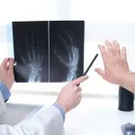 Artrosi: cos’è e come contrastarla